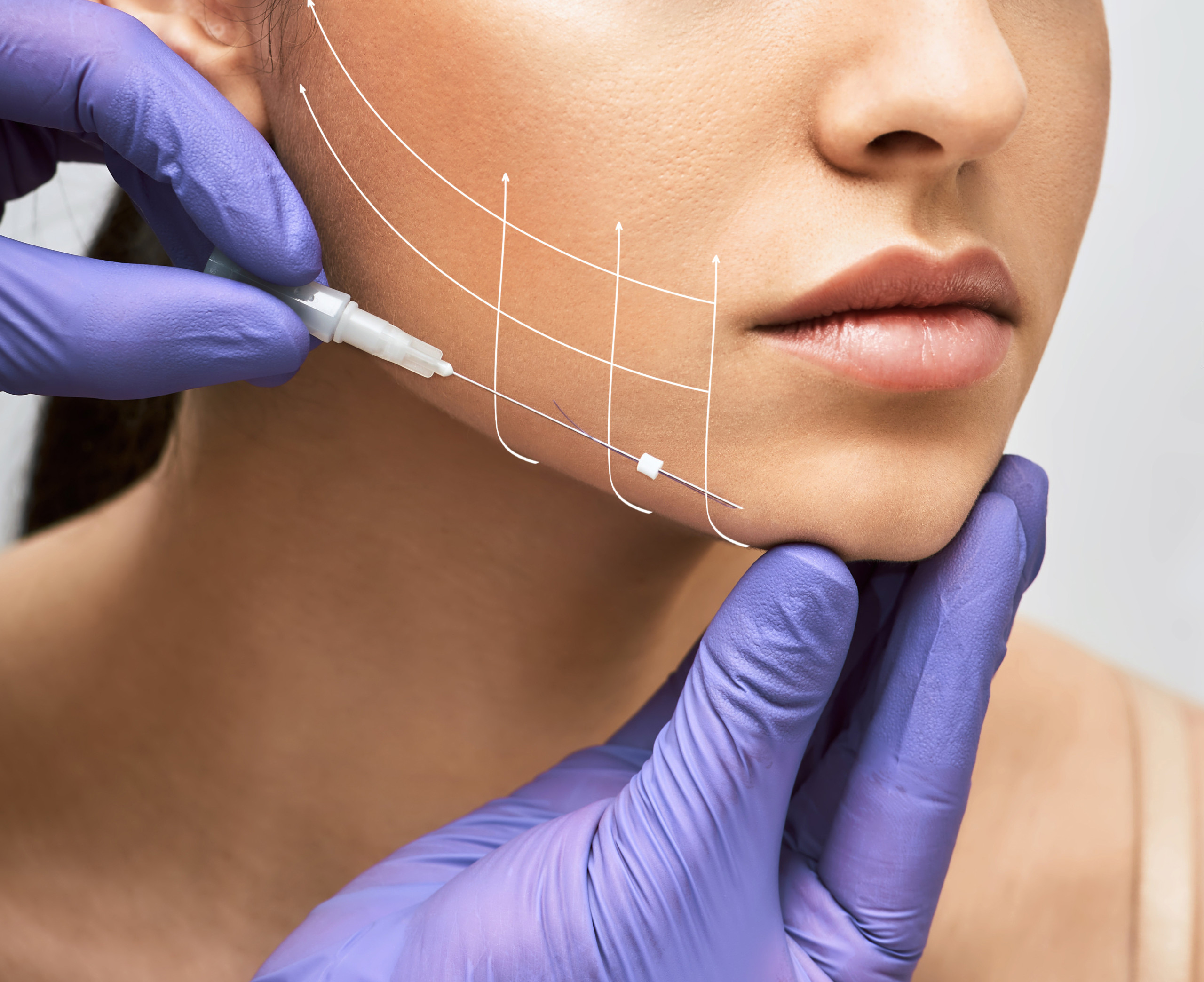 PDO Thread Lift Resuspension at Derma Vogue Dubai